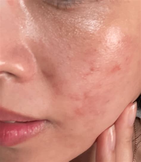 [B&A] This saved my broken skin barrier : r/SkincareAddiction