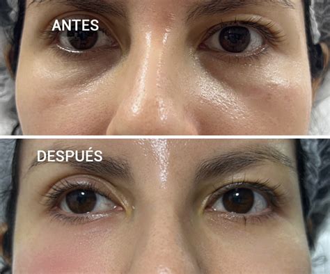 atenuacion de ojeras rellenos faciales clinica chavarri