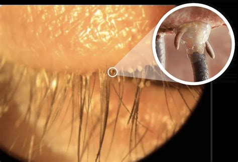 demodex blepharitis xdemvy lotilaner ophthalmic solution