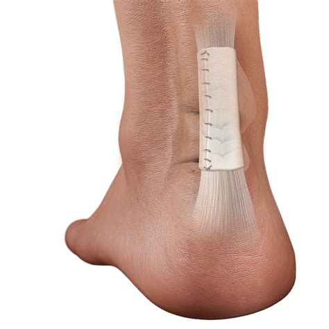 Biologic Scaffold Use in Foot & Ankle Tendon Repairs
