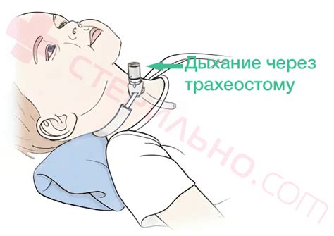 Особенности трахеостомы у детей