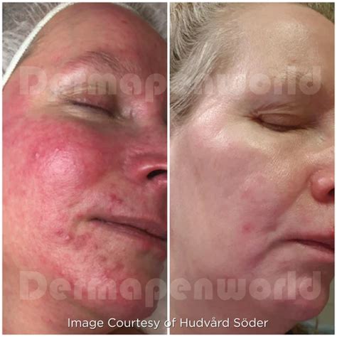 transform  skin microneedling   results
