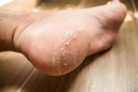 how to remove foot calluses at home
