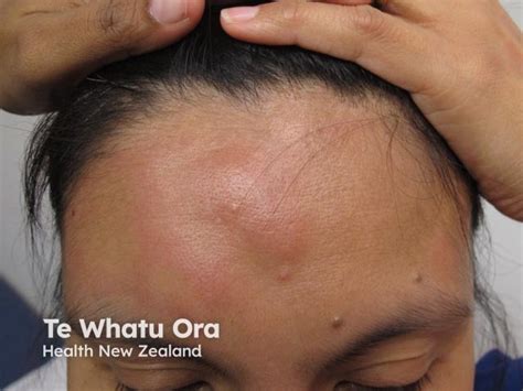 dermnet  zealand images   dermnet