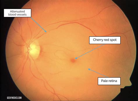 Ophthalmoscopic Examination Of The Retina Reveals Av Banking at Alice
