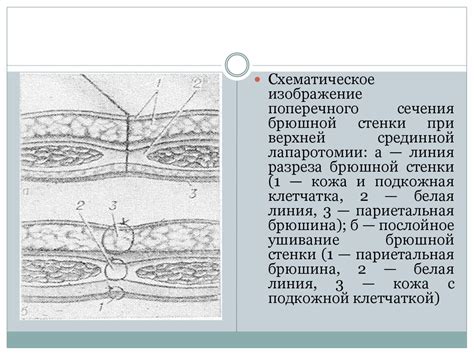 Лапаротомии. Виды лапаротомий - презентация онлайн