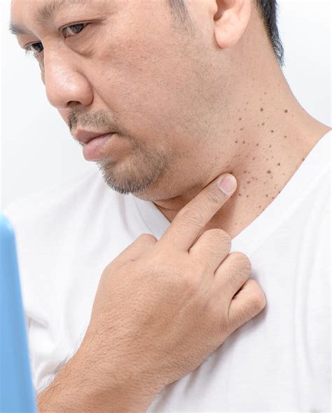 Seborrheic Keratoses and Skin Tags - Gem State Dermatology