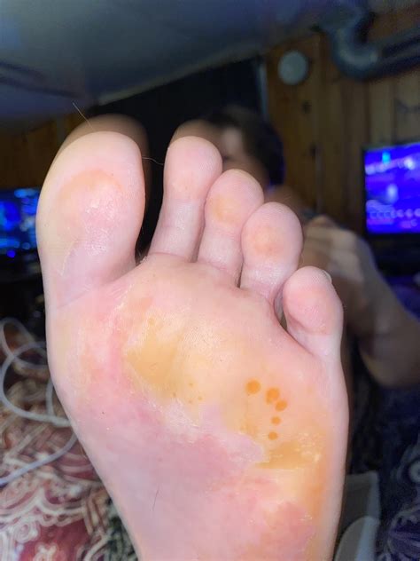 Orange spots on bottom of foot — more info in comments! : r/medical_advice
