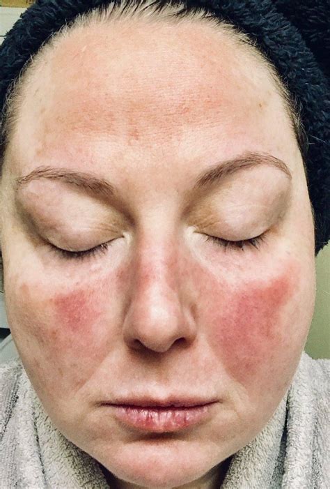 Lupus définition cause et symptôme. 9 plantes de guérison