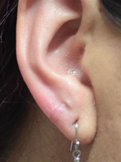Earlobe Repair Glue Name 8