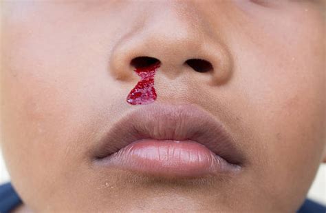 120+ Kid Nose Bleed Stock Photos, Pictures & Royalty-Free Images - iStock