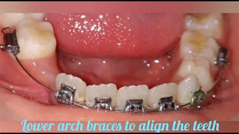 Braces treatment to correct ectopic eruption of lower incisors in 9 ...