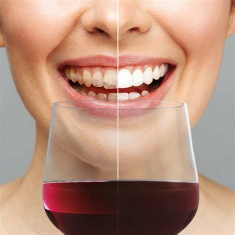Quantos Dias Depois Do Clareamento Posso Tomar Café - Posso tomar vinho ou café após o clareamento dental? | Ciotti Odontologia