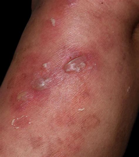Vesicular Skin Lesions: Causes, Symptoms, Diagnosis, Treatment