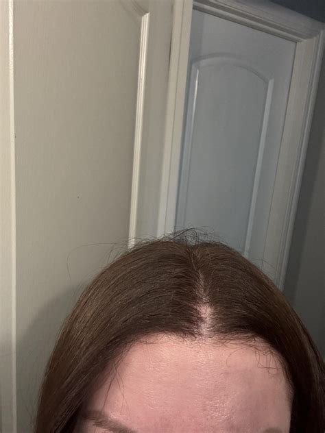 Sudden bald spot. Why is this happening? : r/Hairloss