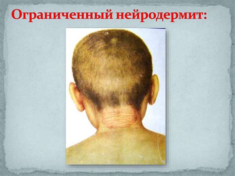 Аллергические заболевания кожи - презентация онлайн