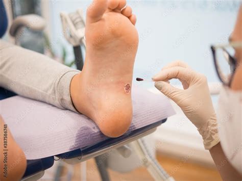 how to prevent spread of plantar warts at home