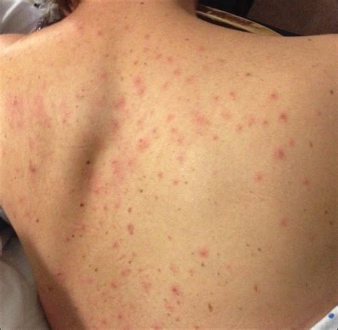 Follicular Lymphoma Symptoms