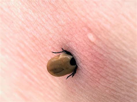 Tick-borne diseases are back. Here's the best way to check for tick ...