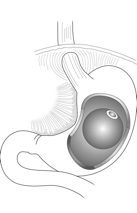 gastric balloon surgery gastricbandclinic