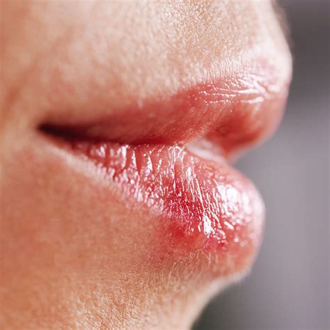 sunburned lips heres  doctors      healthy