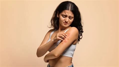 Effective Home Remedies To Relieve Rashes And Itching Easily