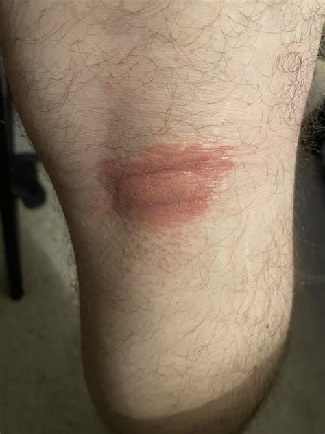 Itchy rash behind knee? Any clue? : r/medical