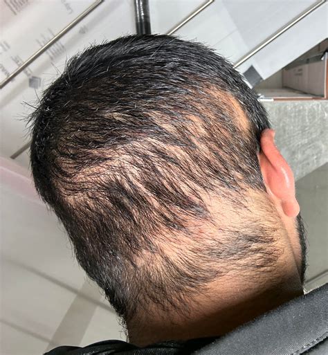 Donor shock loss coming back from the depths : r/HairTransplants