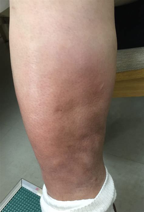 Dermatitis Caused by Untreated Varicose Veins and Its Countermeasures