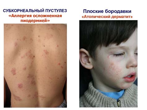Нейродерматозы - online presentation