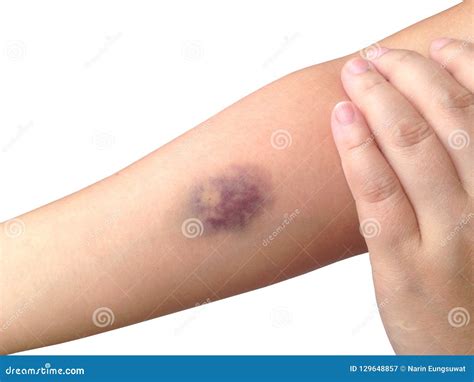 Bruises From Blood Collection Isolated On White Background. Royalty ...