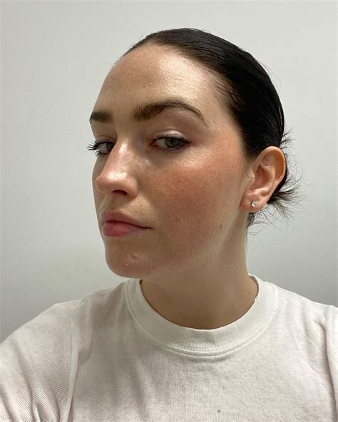 Hyaluronic Acid Fillers: Benefits, Drawbacks, Cost and More | Who What ...