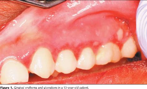 Figure 1 from A young patient with persistent gingival bleeding ...