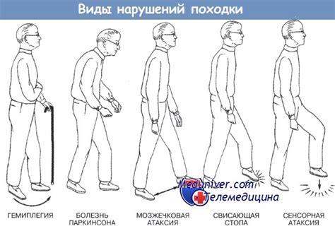 Нарушение ходьбы с атрофией мышц. Нарушение ходьбы без неврологических ...