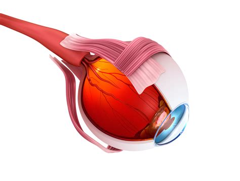 Sickle Cell Retinopathy Focus of Expert Analysis Updating Advice on ...