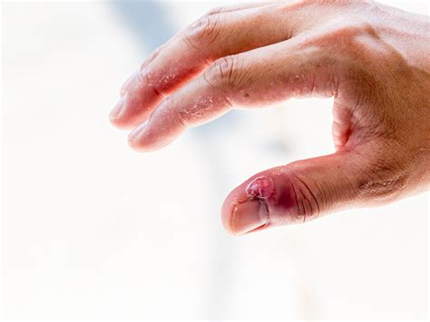 how to stop skin peeling on fingers near nails 7