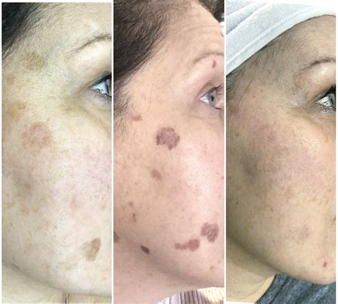 laser removal  brown spots  skin bmth