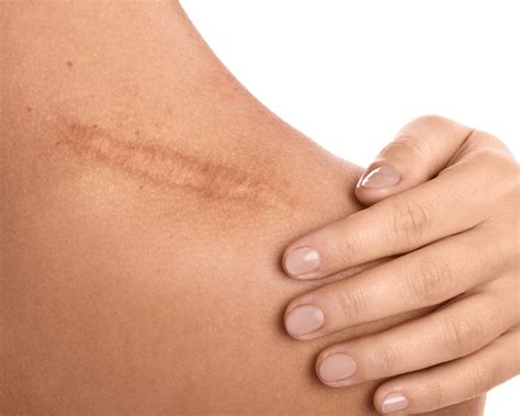 Healing Edges: Navigating Excellence in Surgical Incisions - The