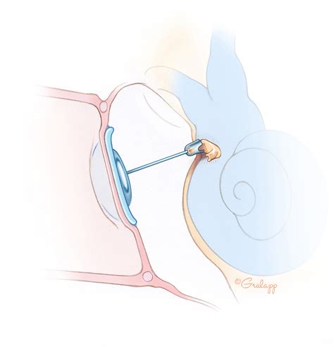 Prosthetic Ossiculoplasty – Oto Surgery Atlas