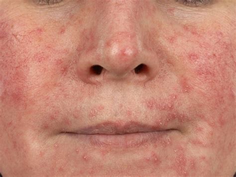Folliculitis (patientenfolder)