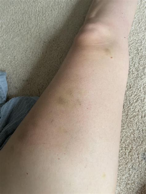 Bruising without injury : r/DermatologyQuestions