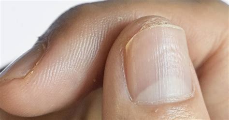 Normal Fingernail Color