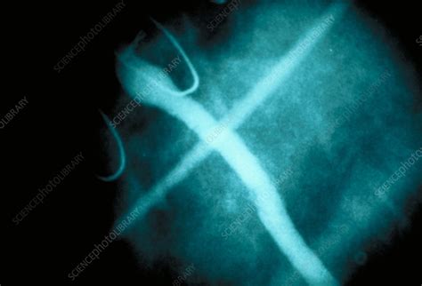 angiogram stock image  science photo library