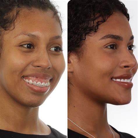 Antes E Depois Giovanna Jacobina - BBB 25: Giovanna Jacobina fez enxerto de gordura da barriga no rosto ...