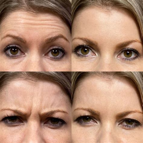 Dynamic vs. Static Wrinkles: What Are The Treatments?