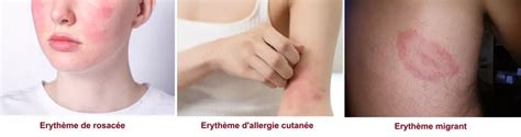 Erythème : c'est quoi, symptômes, comment le traiter ? | Pharmacie de ...
