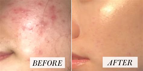 Everything You Need To Know About The Viral Ear Pimple Pop Videos Trending On Social Media Right Now 1