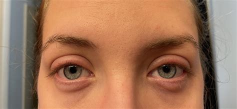 Swollen Eyelid From Makeup Treatment | Makeupview.co