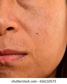 bad face skin stock photo  shutterstock