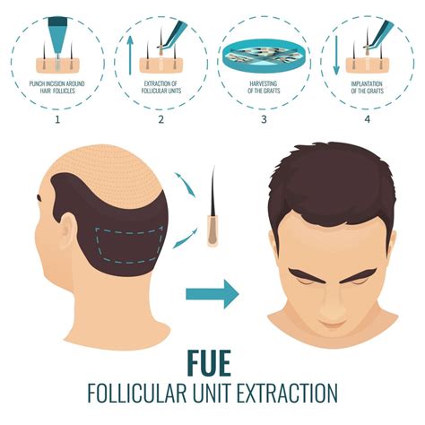 Hair Loss Solution - FUE Hair Transplant | Dr Chen Tai Ho | Malaysia